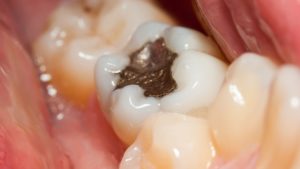 amalgam filling