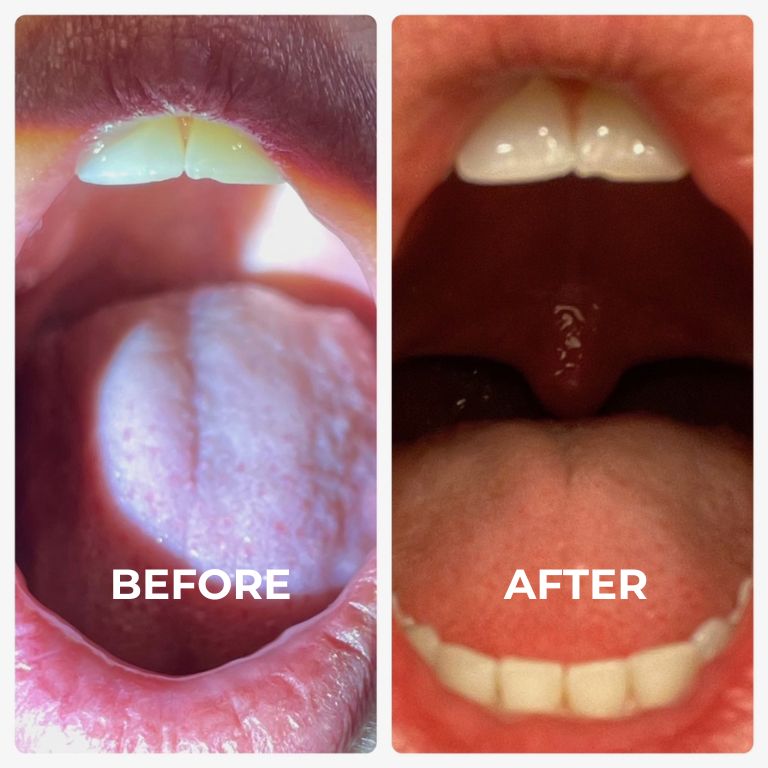 NightLase® procedures before and after pictures 2