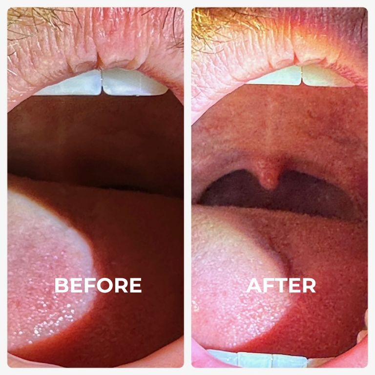 NightLase® procedures before and after pictures