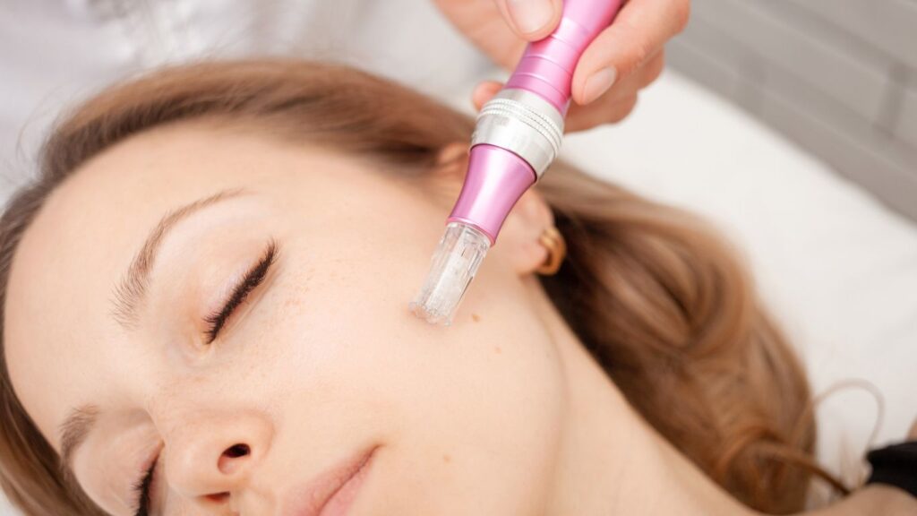 prf microneedling being applied to the cheek
