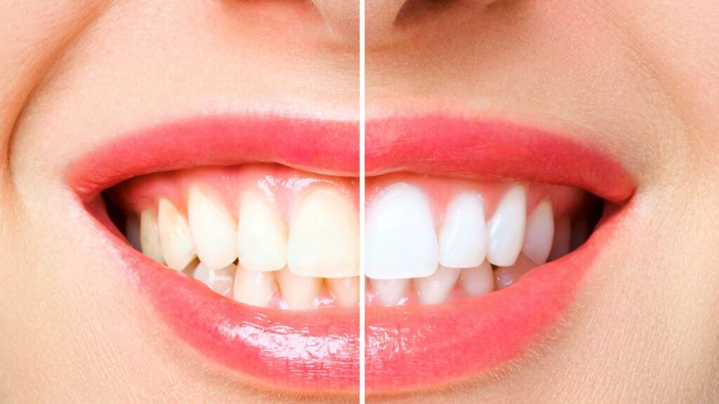 before and after cosmetic dentist