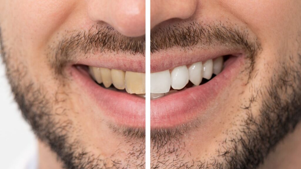 laser teeth whitening before and after